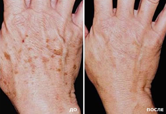 Химический пилинг рук
