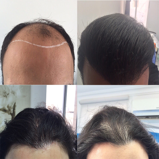 Новинка! Имплантация биоволос