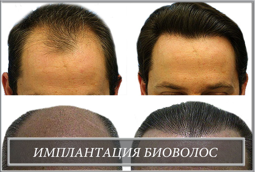 Имплантация биоволос