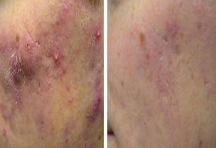 Работа наших врачей:  процедура лазерного омоложения Laser Genesis