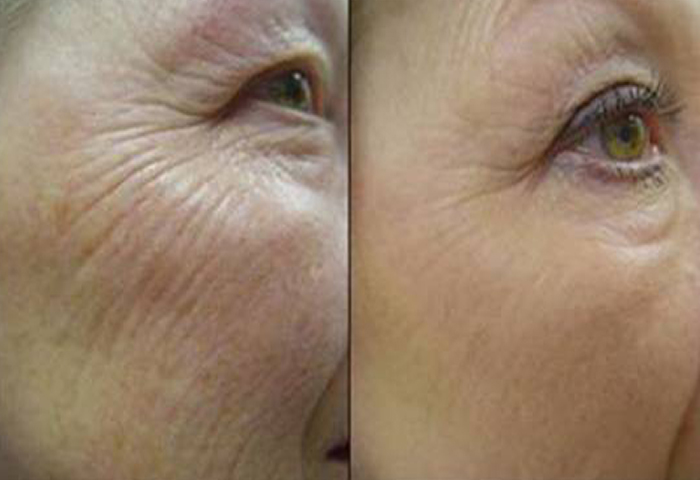 Работа наших врачей:  процедура лазерного омоложения Laser Genesis