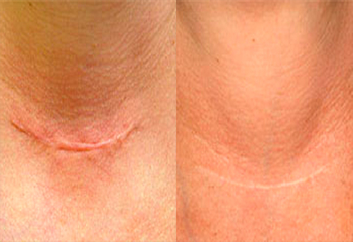 Работа наших врачей:  процедура лазерного омоложения Laser Genesis