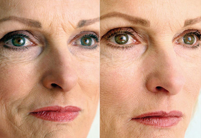 Работа наших врачей:  процедура лазерного омоложения Laser Genesis