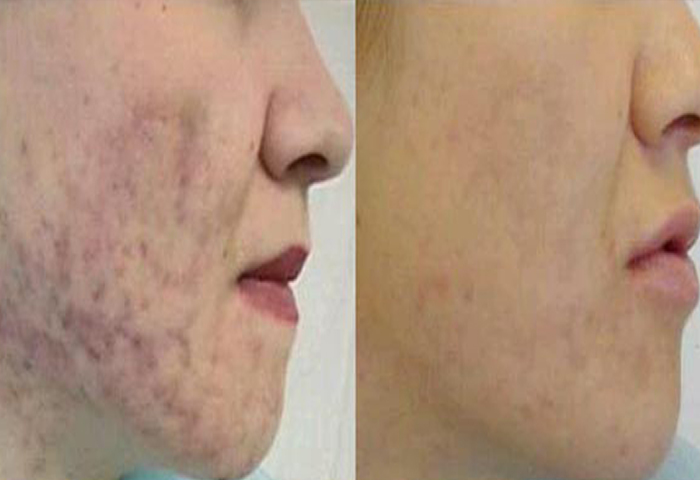 Работа наших врачей:  процедура лазерного омоложения Laser Genesis