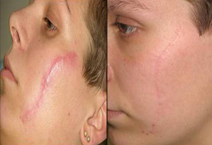 Работа наших врачей:  процедура лазерного омоложения Laser Genesis