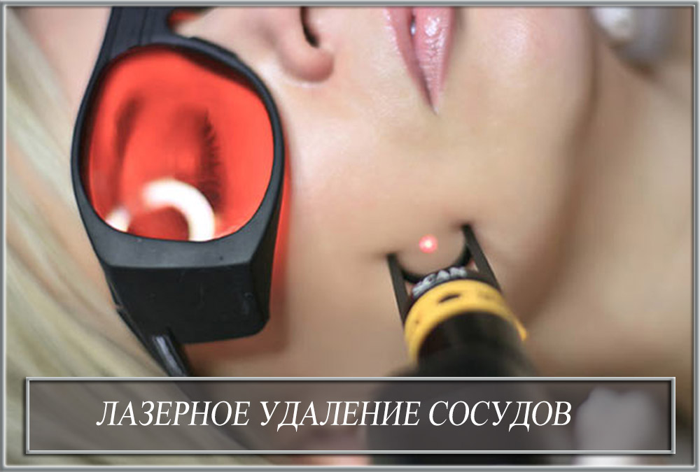 Лазерное удаление сосудов