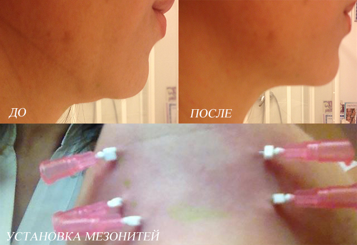 Коррекция "второго подбородка"