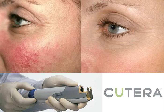 Работа наших врачей: удаление сосудов неодимовым лазером Cutera.