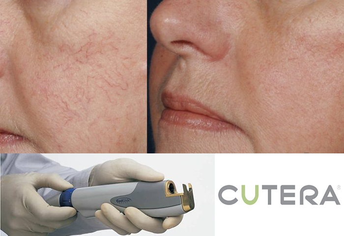 Работа наших врачей: удаление сосудов неодимовым лазером Cutera.