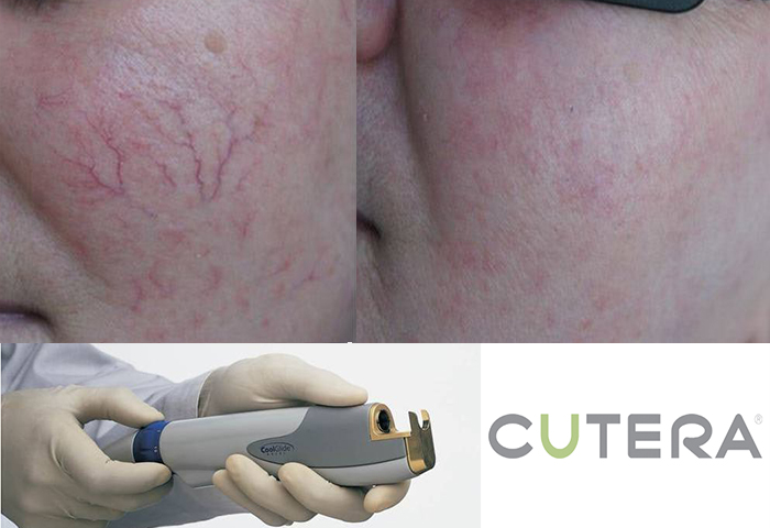 Работа наших врачей: удаление сосудов неодимовым лазером Cutera.