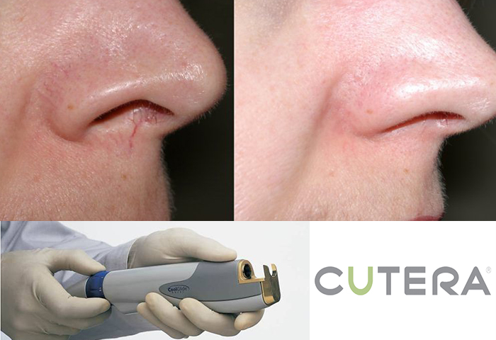 Работа наших врачей: удаление сосудов неодимовым лазером Cutera.