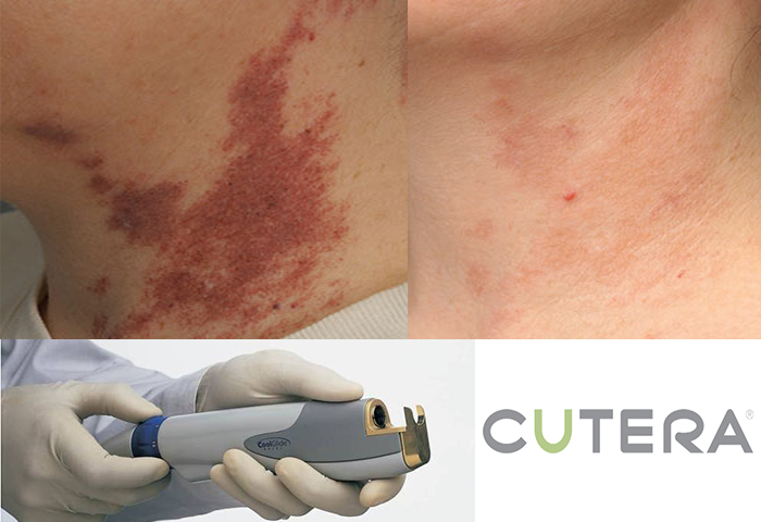 Работа наших врачей: удаление сосудов неодимовым лазером Cutera.