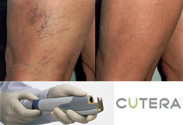 Работа наших врачей: удаление сосудов неодимовым лазером Cutera.