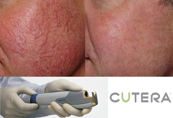 Работа наших врачей: удаление сосудов неодимовым лазером Cutera.