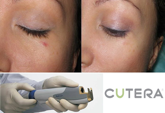 Работа наших врачей: удаление сосудов неодимовым лазером Cutera.