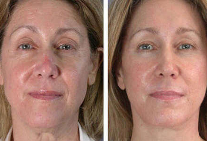 Работа наших врачей: безоперационная подтяжка кожи.