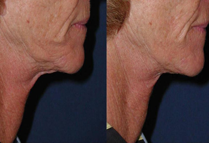 Работа наших врачей: безоперационная подтяжка кожи.