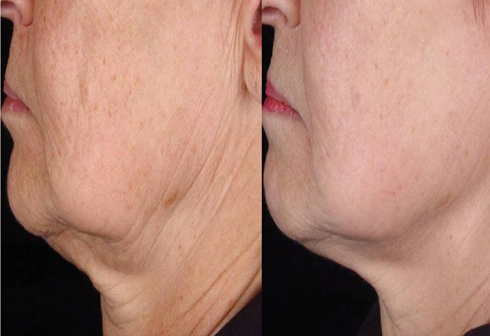 Работа наших врачей: безоперационная подтяжка кожи.