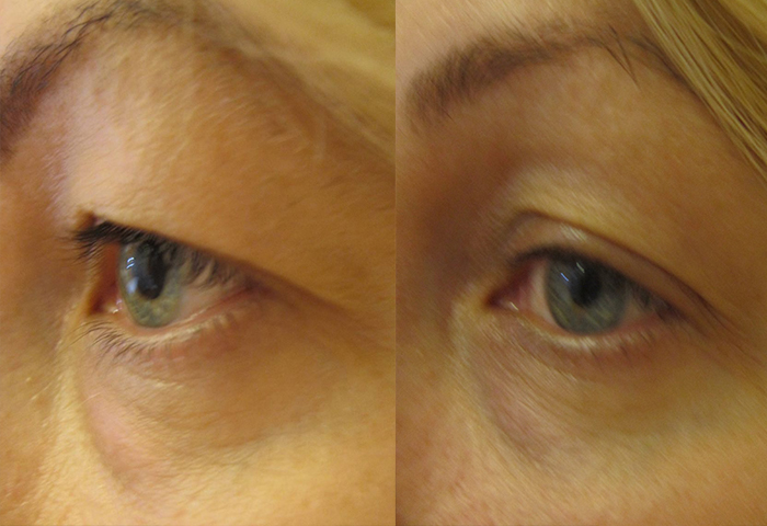 Работа наших врачей: безоперационная подтяжка кожи.