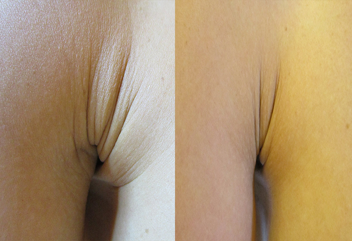 Работа наших врачей: безоперационная подтяжка кожи.