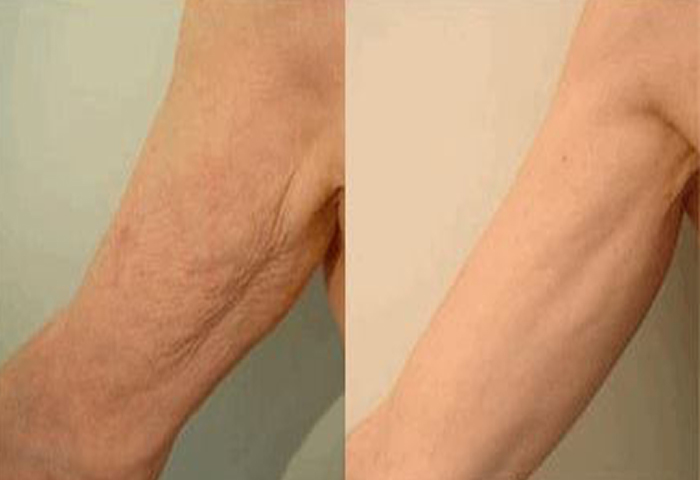 Работа наших врачей: безоперационная подтяжка кожи.