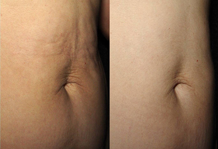 Работа наших врачей: безоперационная подтяжка кожи.