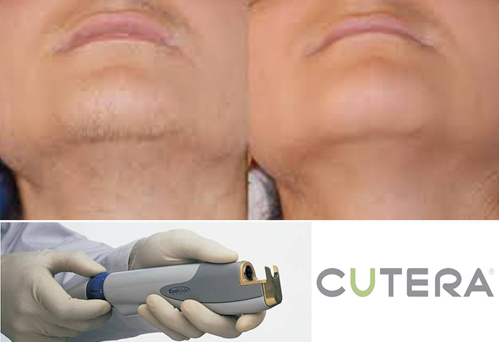 Работа наших врачей: удаление нежелательных волос неодимовым лазером Cutera.