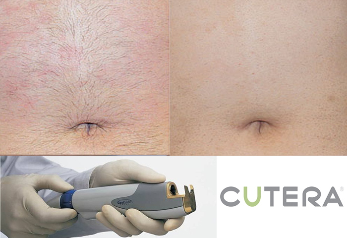Работа наших врачей: удаление нежелательных волос неодимовым лазером Cutera.