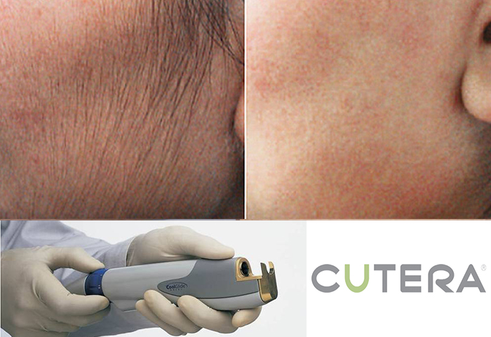 Работа наших врачей: удаление нежелательных волос неодимовым лазером Cutera.