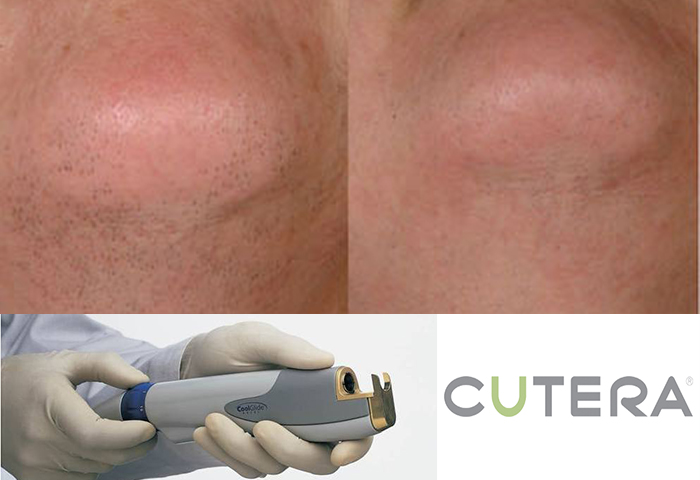 Работа наших врачей: удаление нежелательных волос неодимовым лазером Cutera.
