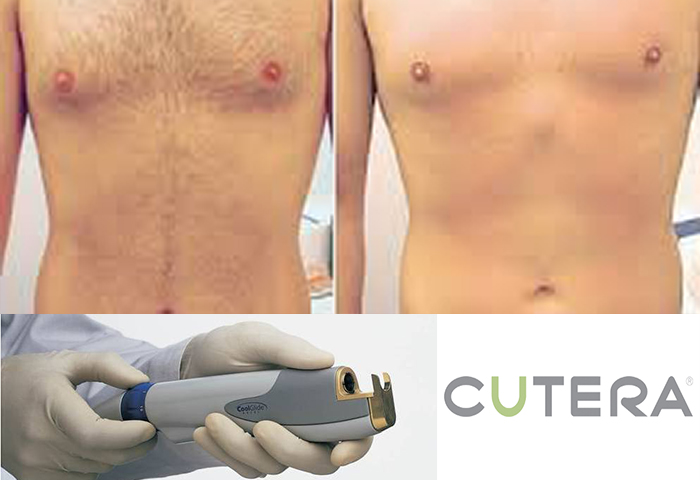 Работа наших врачей: удаление нежелательных волос неодимовым лазером Cutera.