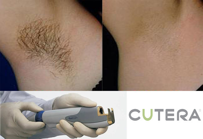 Работа наших врачей: удаление нежелательных волос неодимовым лазером Cutera.